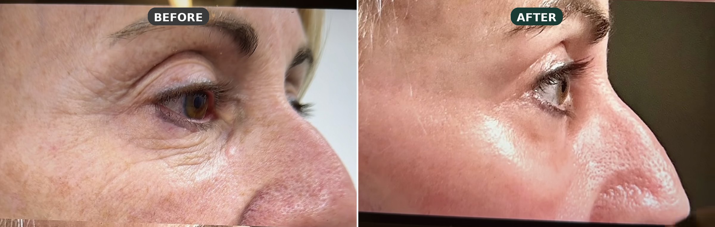 Before and after fractional CO2 laser resurfacing — patient of Dr. Peter Malouf.