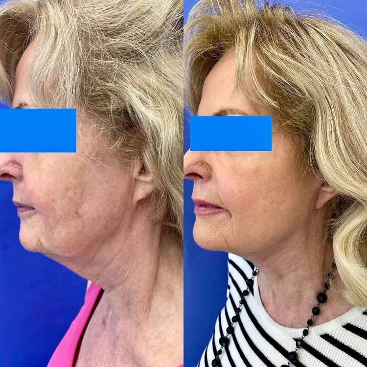 Safelift mini-facelift result performed under local anesthesia by Dr. Peter Malouf.