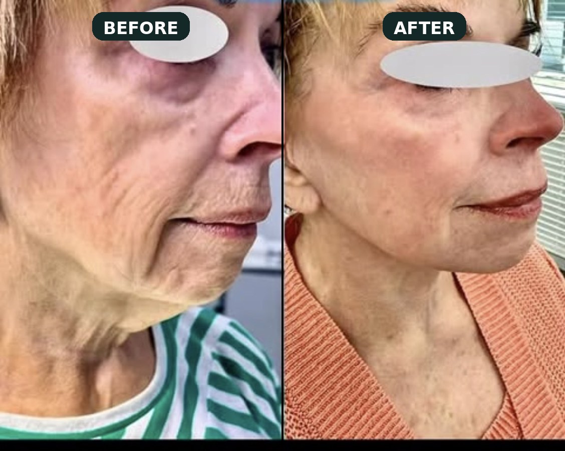 Mini neck lift result — jawline definition under local anesthesia.