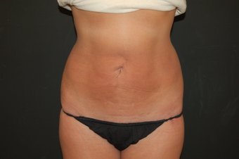 Smarter Lipo body contouring result under local tumescent anesthesia.