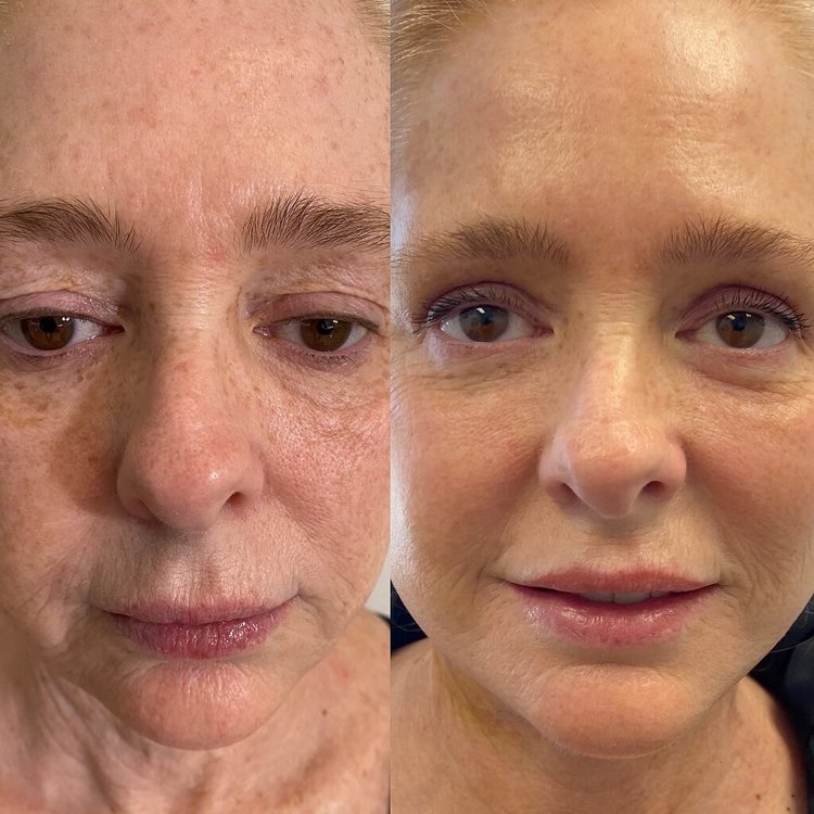 Upper-lid blepharoplasty result — refreshed, less-hooded eyes.